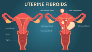 Fibroids Awareness Month